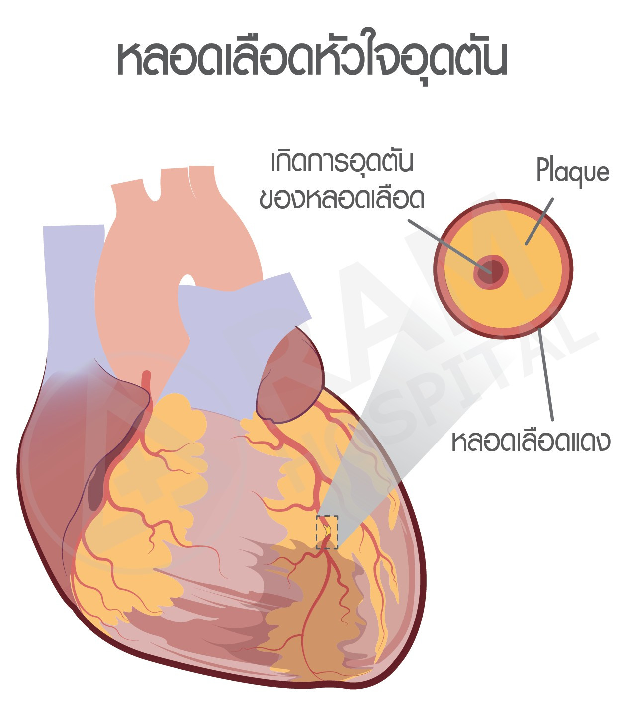 sudden cardiac death