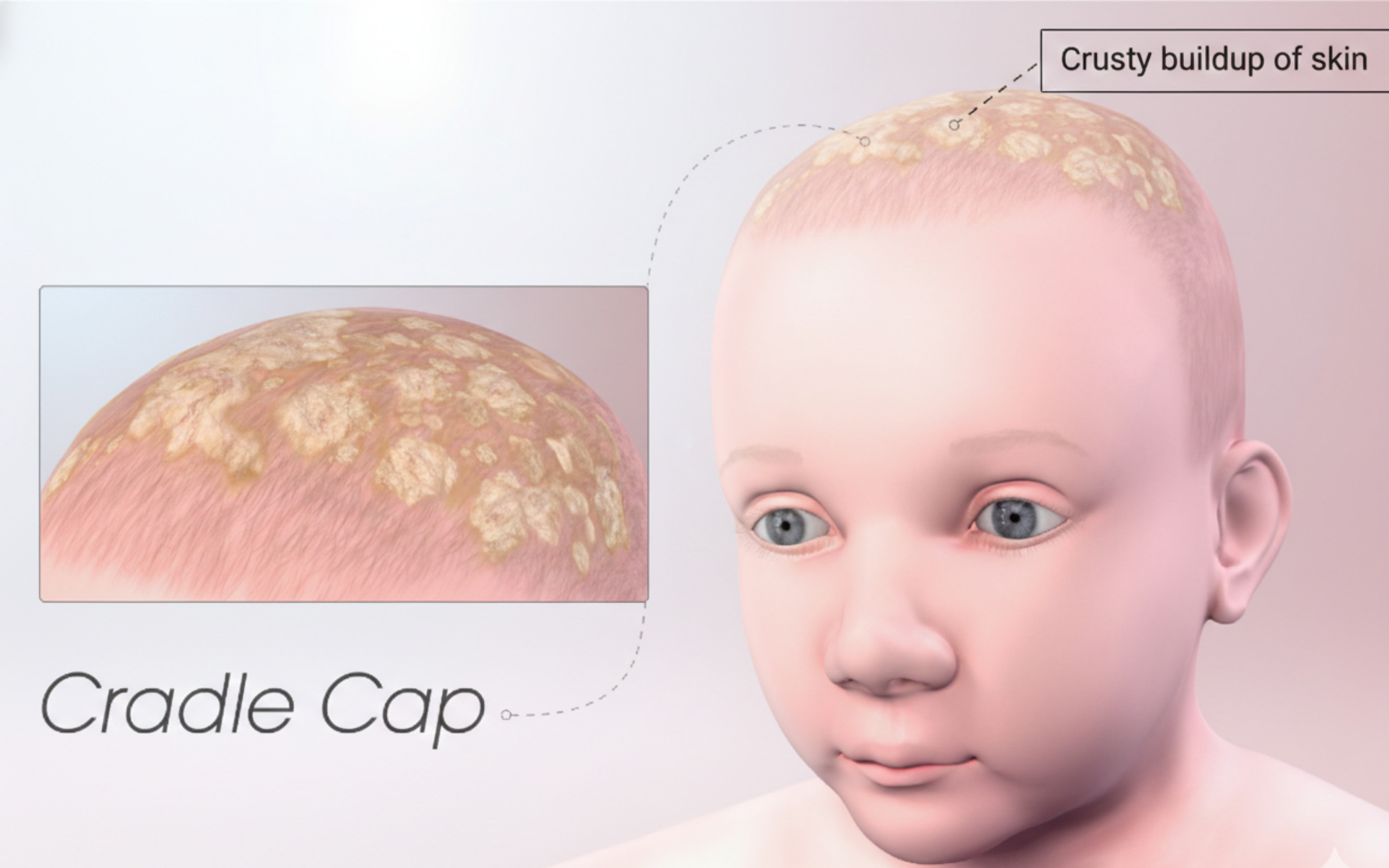 ไขบนหัวทารก