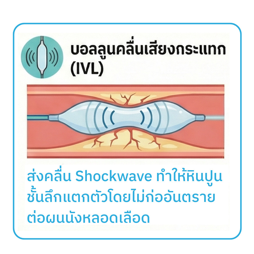 รักษาหัวใจตีบซับซ้อนที่มีหินปูนเกาะหนา complex PCI
