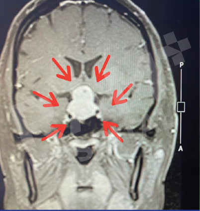 经鼻内镜下垂体瘤手术中心