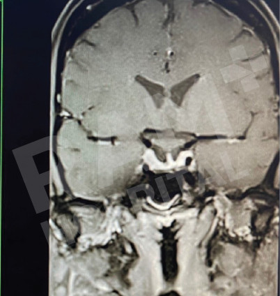 经鼻内镜下垂体瘤手术中心
