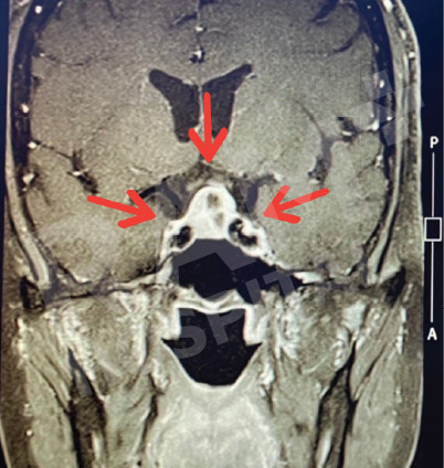 经鼻内镜下垂体瘤手术中心
