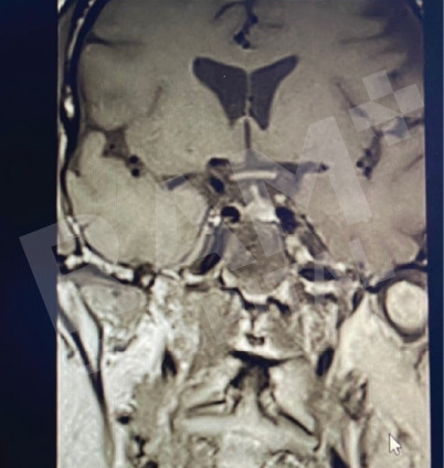 经鼻内镜下垂体瘤手术中心