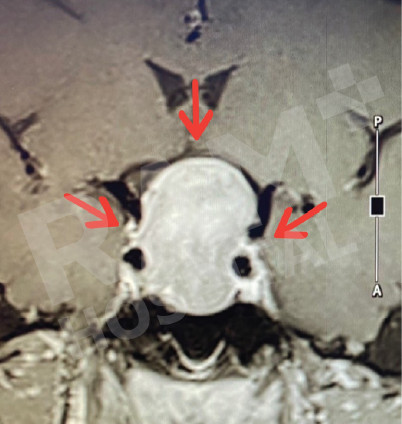 经鼻内镜下垂体瘤手术中心
