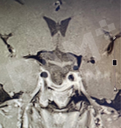 经鼻内镜下垂体瘤手术中心