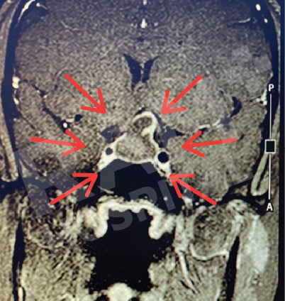 经鼻内镜下垂体瘤手术中心