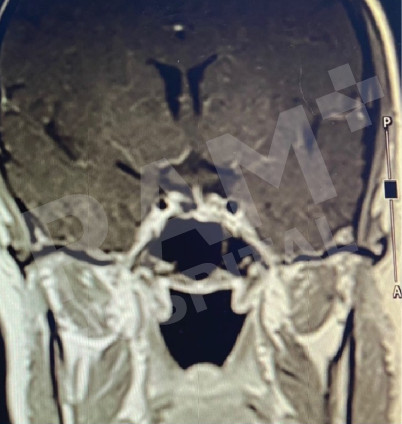 经鼻内镜下垂体瘤手术中心