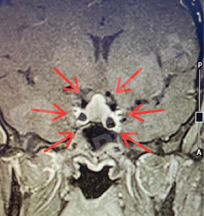 经鼻内镜下垂体瘤手术中心