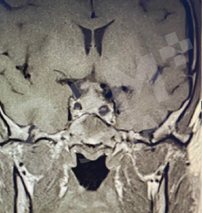 经鼻内镜下垂体瘤手术中心