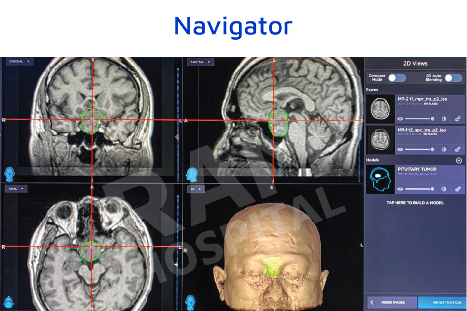 经鼻内镜下垂体瘤手术中心