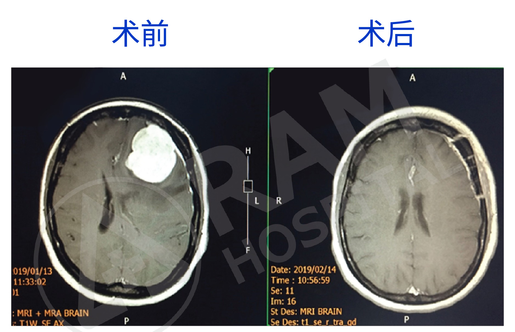 ศูนย์รักษาเนื้องอกในสมอง