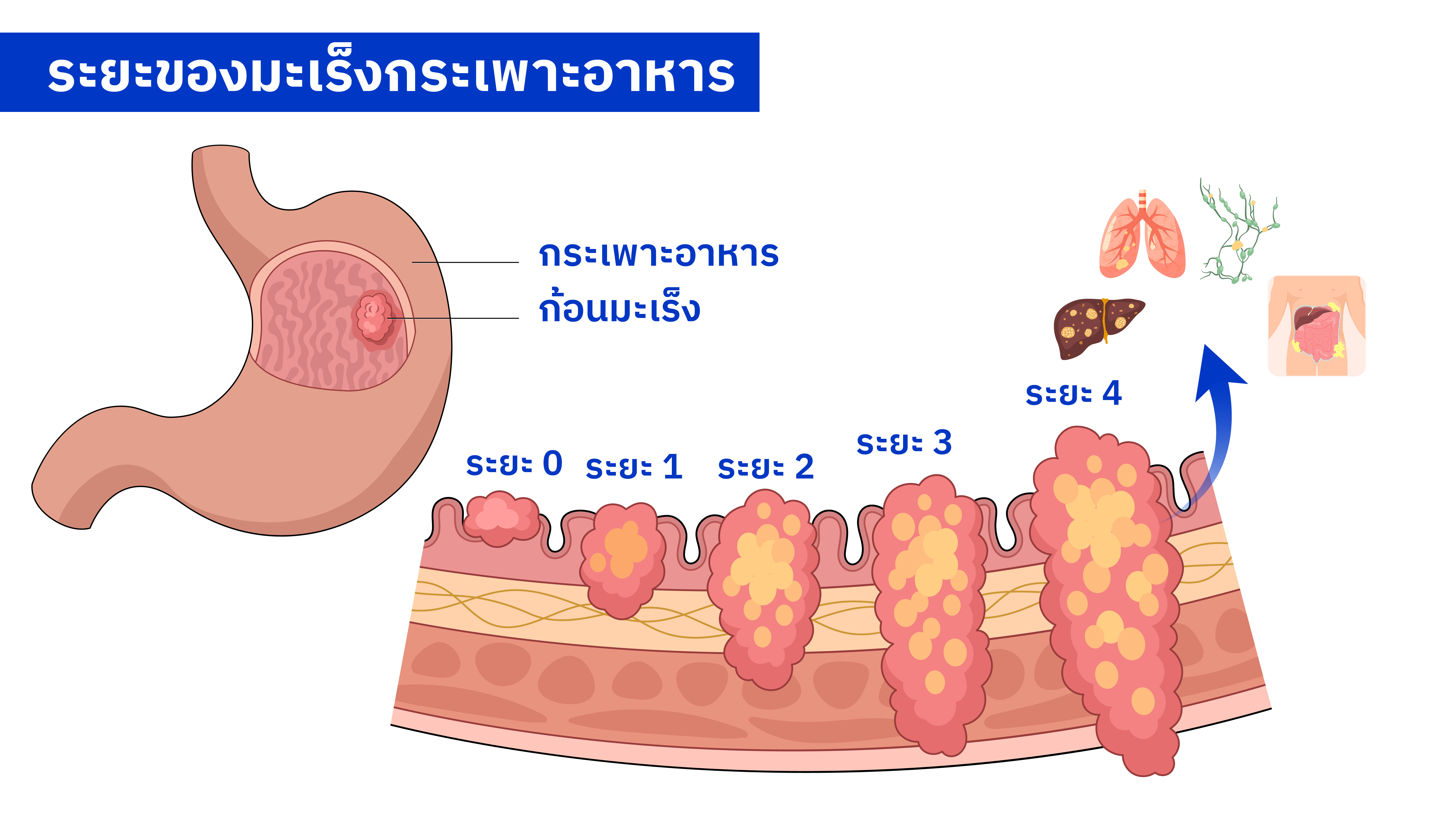 มะเร็งกระเพาะอาหาร