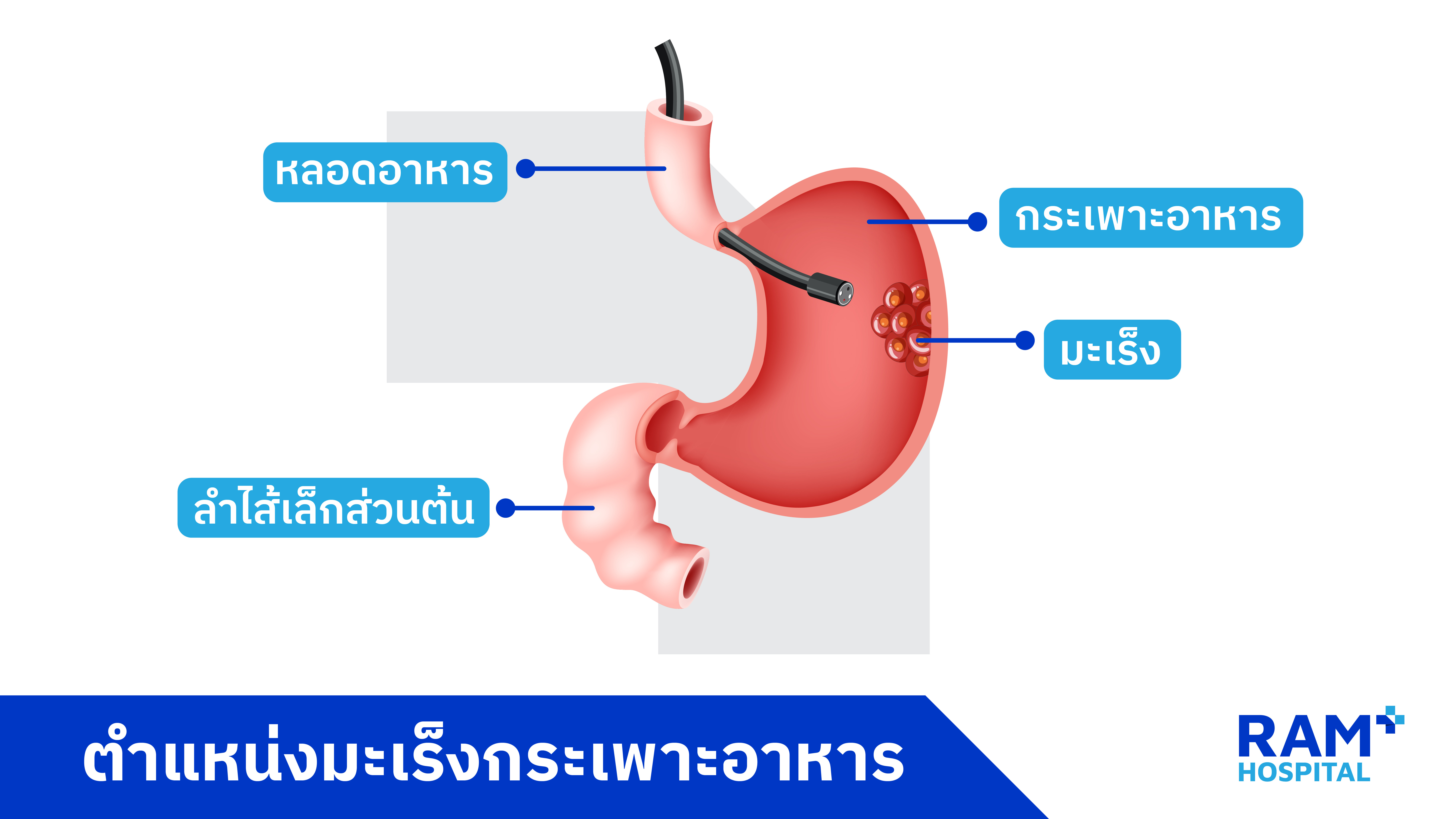 มะเร็งกระเพาะอาหาร