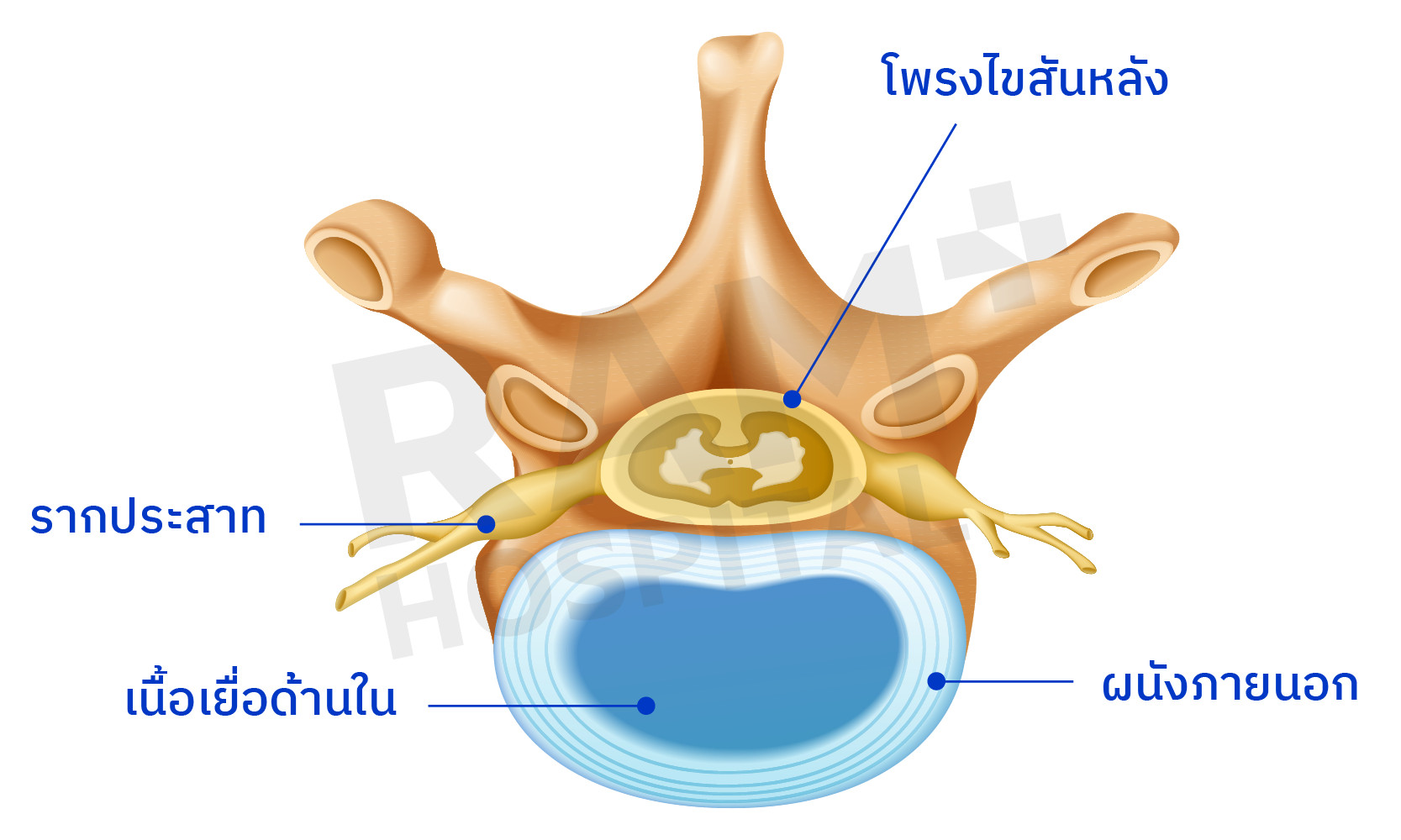 หมอนรองกระดูกสันหลังส่วนเอว