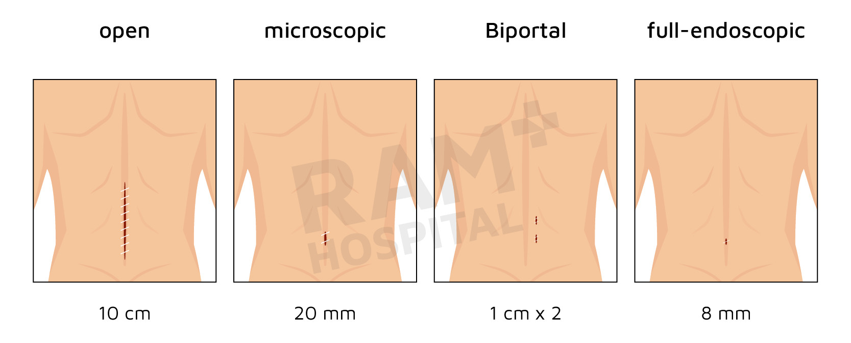 หมอนรองกระดูกทับเส้นประสาท รักษา