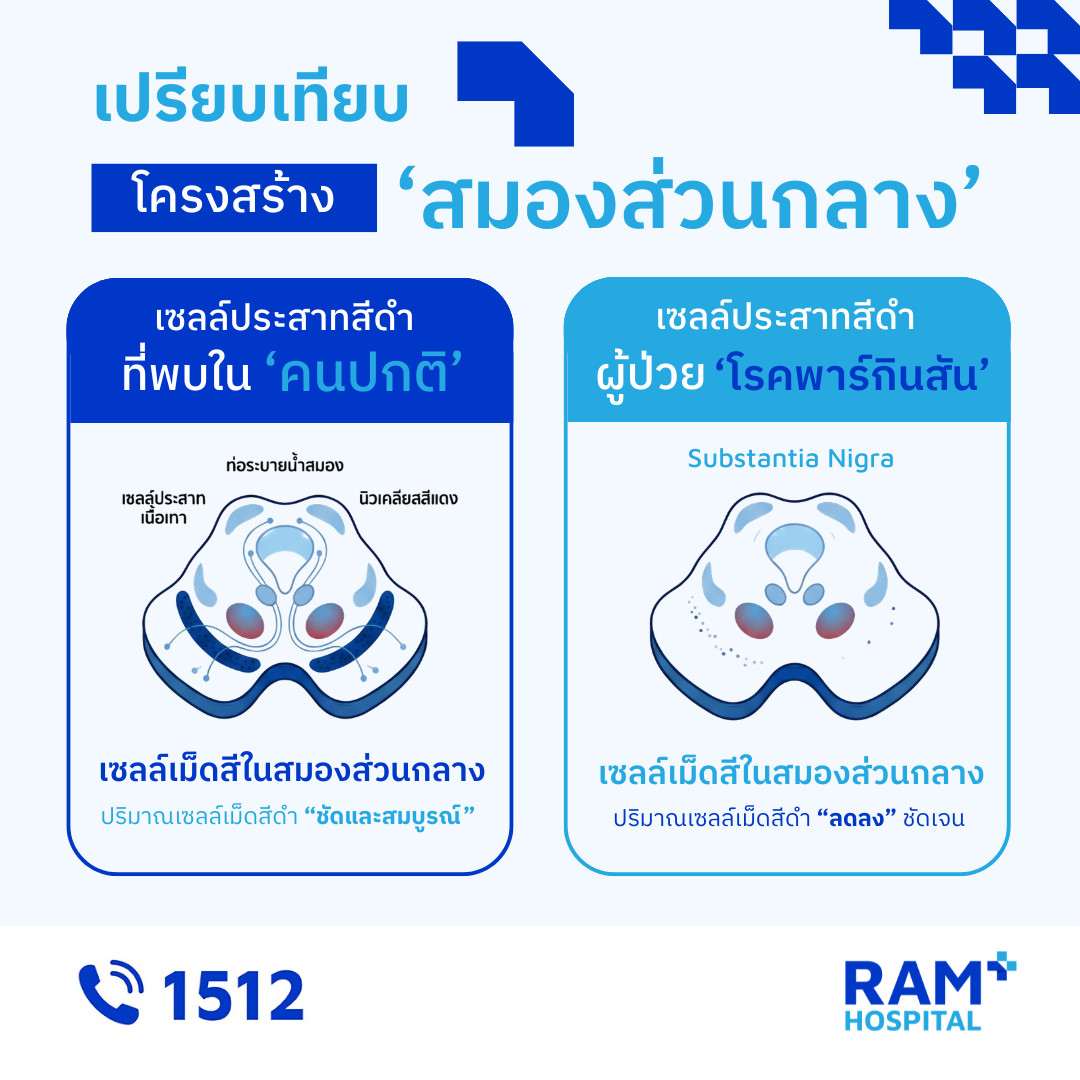 โรคพาร์กินสัน