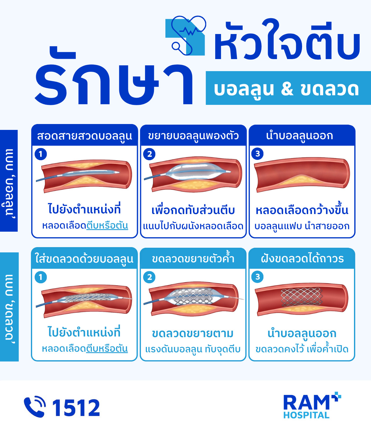 หัวใจตีบ รักษา บอลลูน