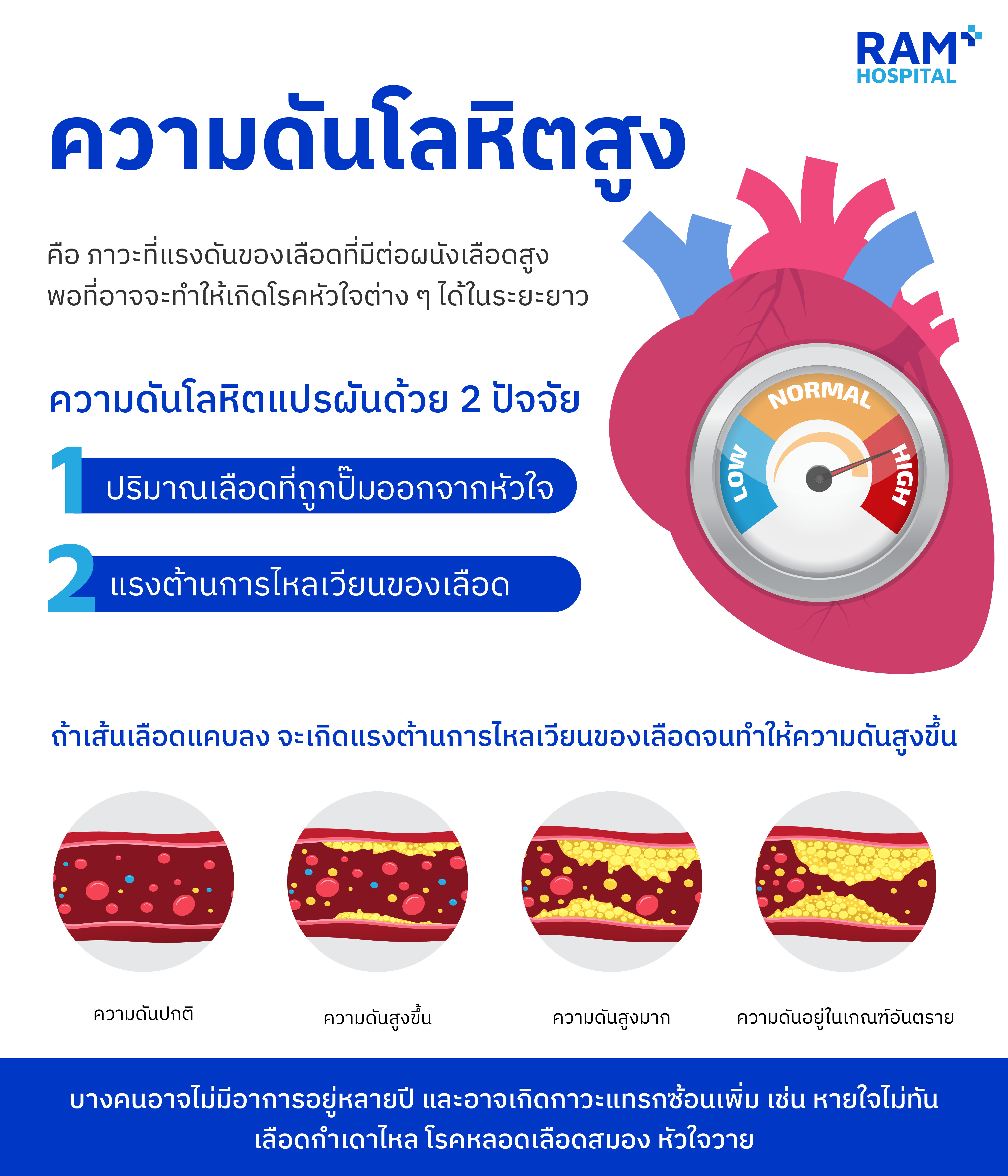 ความดันโลหิตสูง
