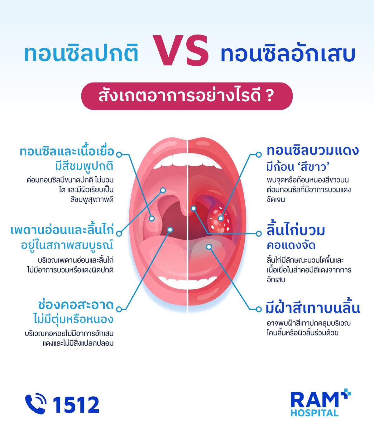 ทอนซิลอักเสบ